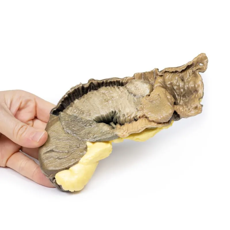 3D Printed Intussusception of Small Bowel Due to Metastatic Tumour